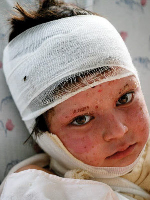 child_head_injury